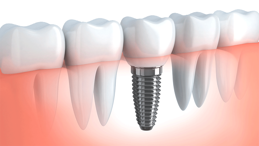 Implantologia-dentale-bologna